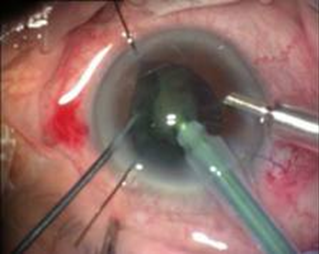 What are some complications that can happen from cataract surgery?