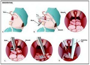 Adenoid Problems and Adenoidectomy
