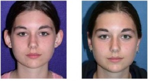 Before and After Otoplasty