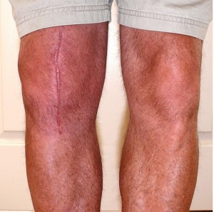Joint Post Knee Arthroplasty