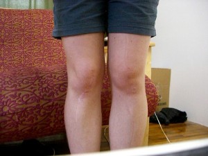 Knee Arthroplasty