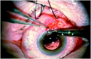 Cataract Surgery Complications