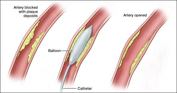 angioplasty procedure