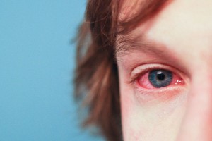 allergic conjunctivitis symptoms