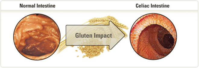 benefits of gluten free diet