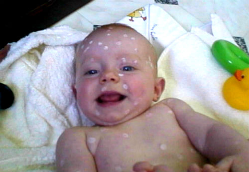 chicken pox in infants